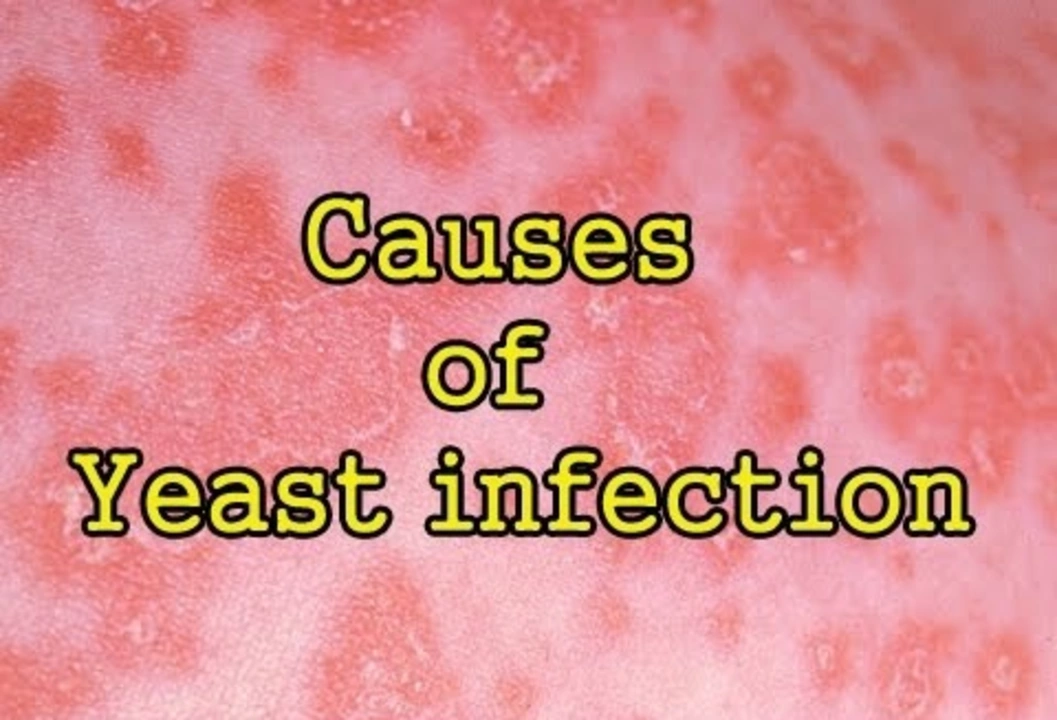 The Connection between Diabetes and Yeast Infections of the Skin