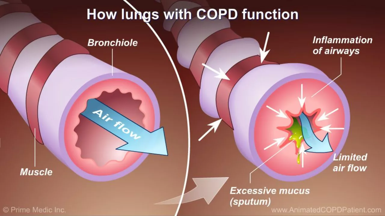 The Link Between Pneumonia and Chronic Obstructive Pulmonary Disease (COPD)